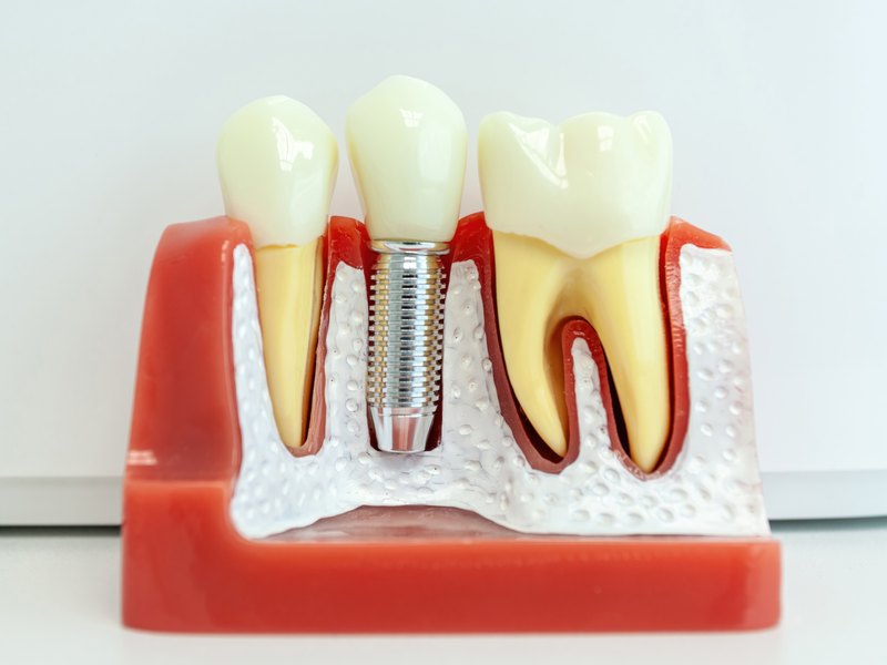 Dental implants