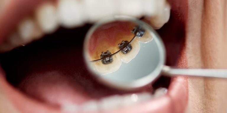 Dental mirror reflecting metal brackets bonded to the inner side of the upper teeth