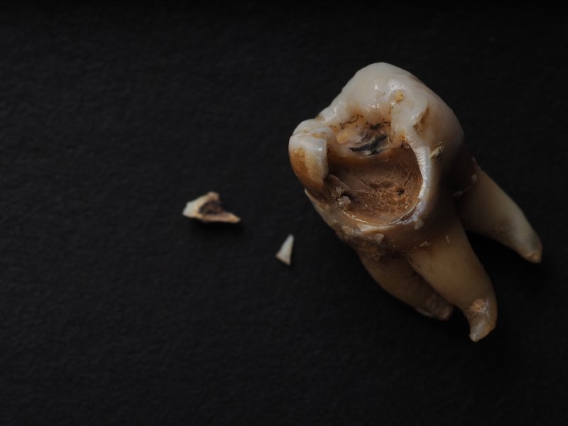 Muela extraída con una caries en la corona y manchas negras en su interior