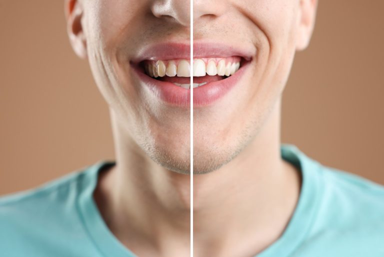 Sonrisa partida en dos: dientes con manchas amarillentas a un lado y blancos al otro