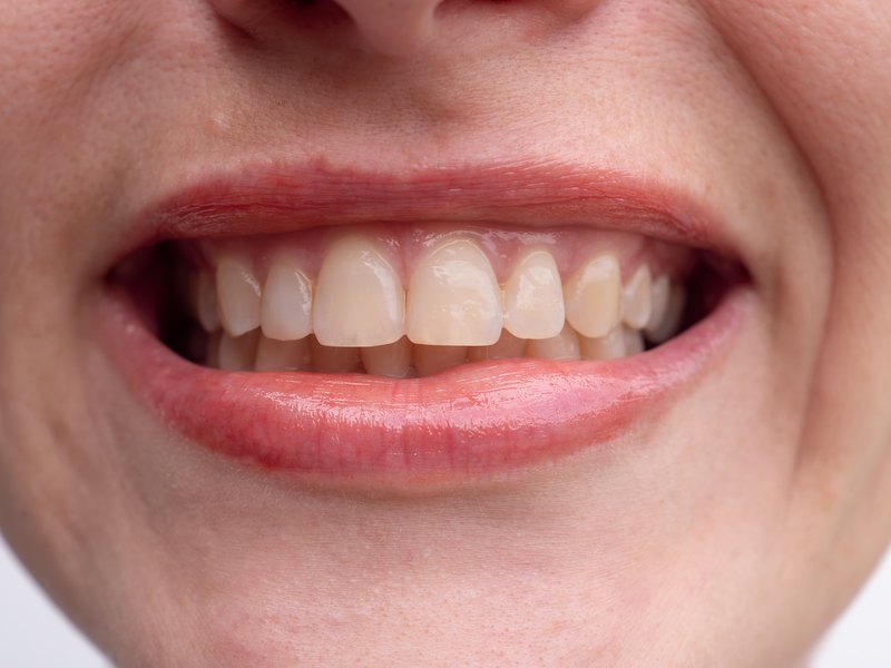 Sonrisa con los incisivos superiores amarillentos y manchas de color ámbar en el esmalte