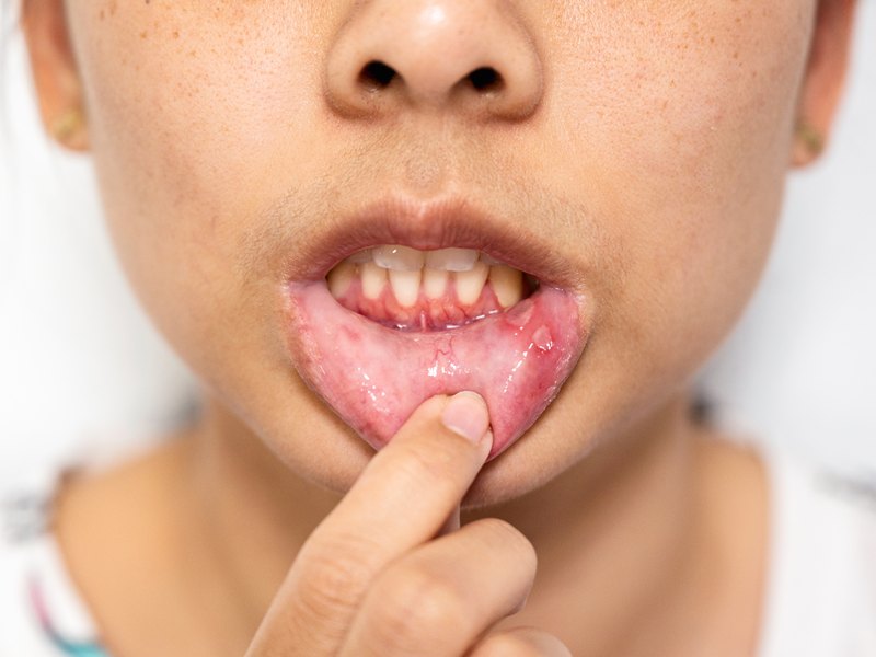 Woman pulling down her lower lip with a finger to show small sores on the lining