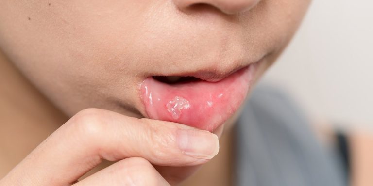 Dona ensenyant una nafra a la cara interna del llavi inferior