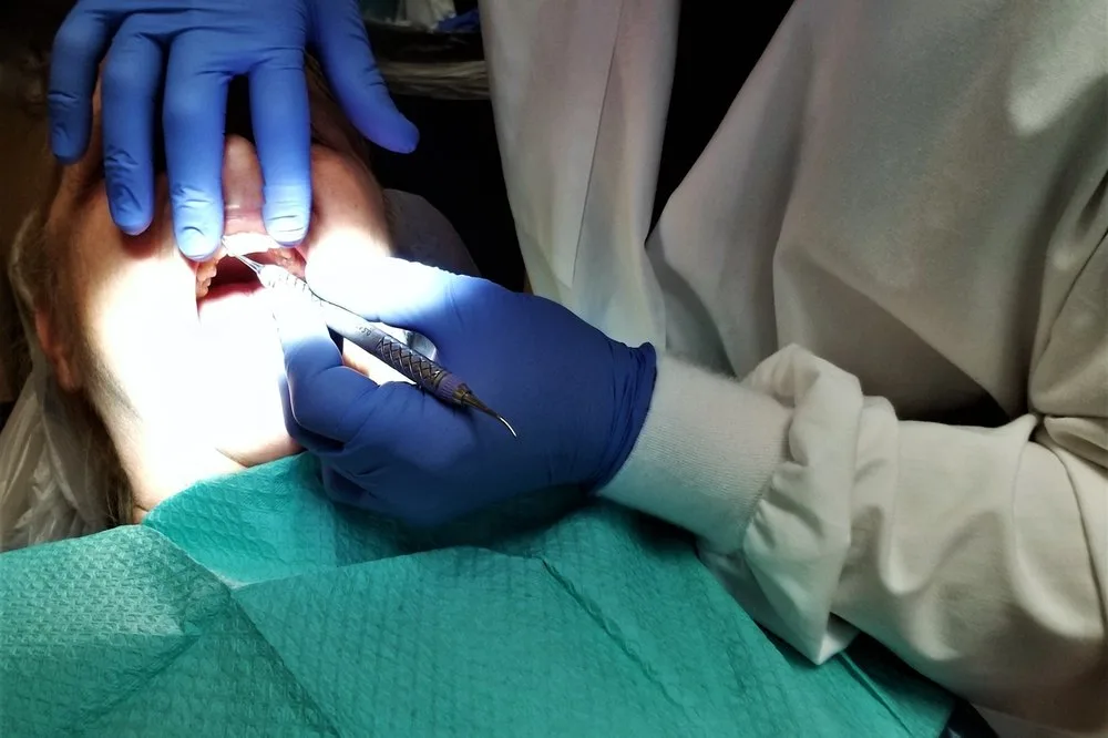 Dentista con guantes azules hace una obturación dental con instrumental fino bajo la luz del sillón, en Barcelona
