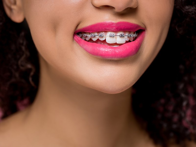 Somriure d'una noia amb pintallavis rosa i brackets metàl·lics