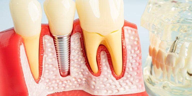 Model dental amb un implant de titani a l'os i la geniva al costat de dents naturals