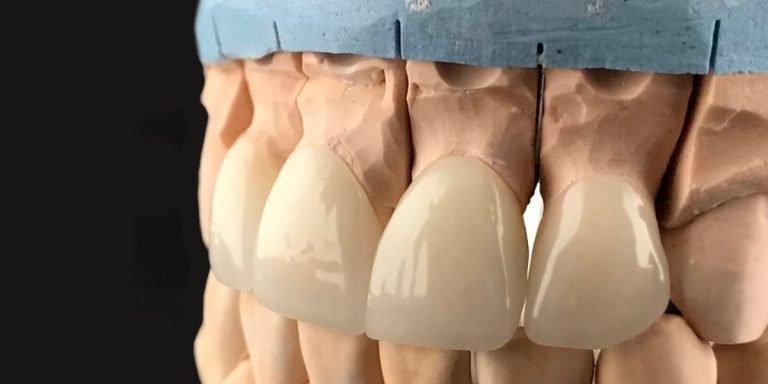 Porcelain veneers fitted on the teeth of a plaster model of the upper arch