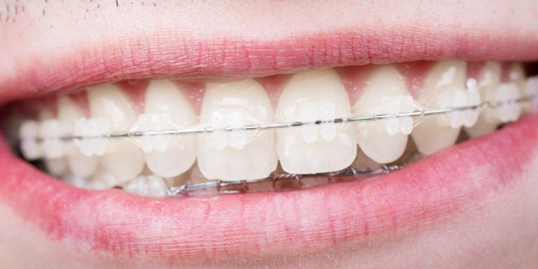 Sonrisa con brackets de cerámica transparentes en los dientes de arriba y el arco metálico fino que los une