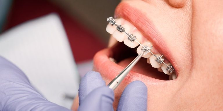 Mano con guante morado ajusta con unas pinzas el arco de los brackets metálicos en los dientes de una paciente