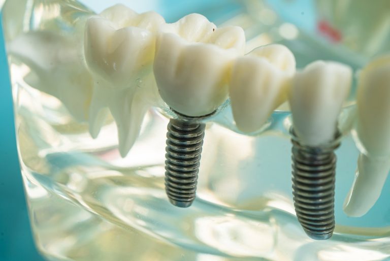 Implantes dentales de titanio con sus coronas en un modelo transparente de la mandíbula