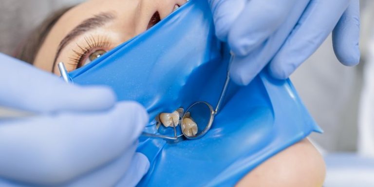 Paciente con dique de goma azul y una grapa que aísla la muela mientras el dentista la revisa con un espejo