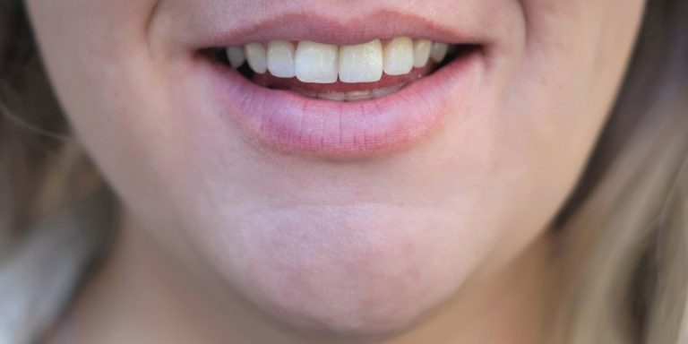 Sonrisa con los dientes de un tono uniforme