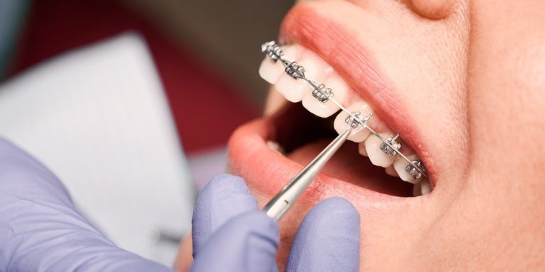 Mà amb guant morat ajusta amb unes pinces l'arc dels brackets metàl·lics a les dents d'una pacient