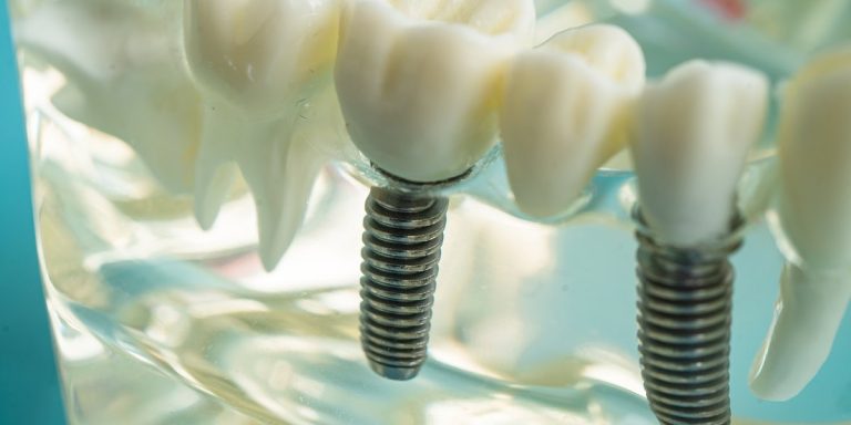 Implants dentals de titani amb les seves corones en un model transparent de la mandíbula