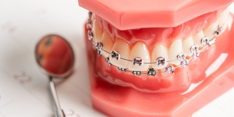 Model dental amb brackets metàl·lics i arc d'ortodòncia al costat d'un mirall dental