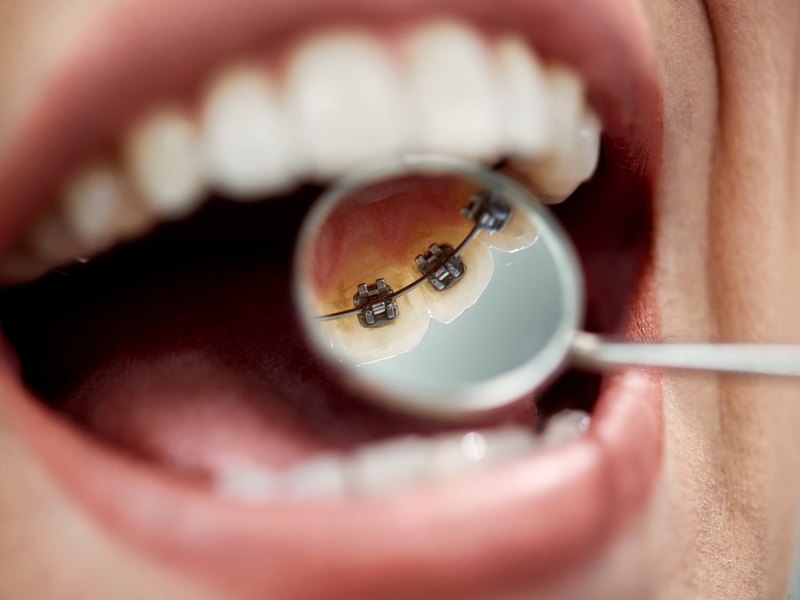Mirall dental que reflecteix els brackets metàl·lics enganxats per darrere de les dents de dalt