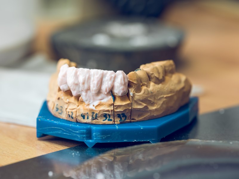 Model dental de guix amb una pròtesi provisional sobre la base del laboratori