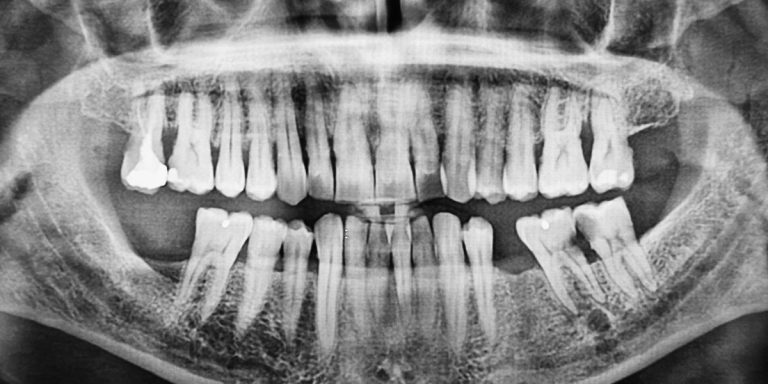 Radiografia panoràmica de la boca amb els queixals del fons de la mandíbula