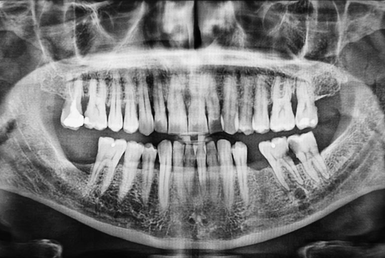 Radiografía panorámica de la boca con las muelas del fondo de la mandíbula