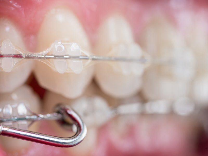 Dientes con brackets cerámicos transparentes y un arco de alambre fino, en primer plano