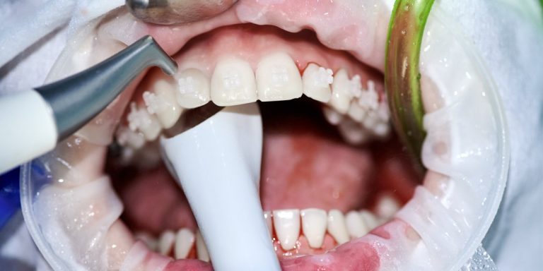 Boca abierta durante una limpieza dental en la consulta