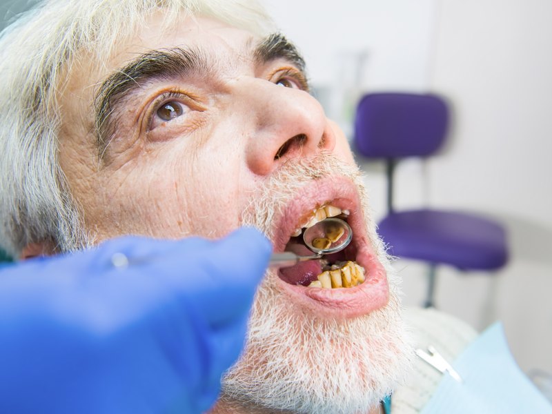 Dents de baix amb placa i tàrtar groguencs vistes amb un mirall dental
