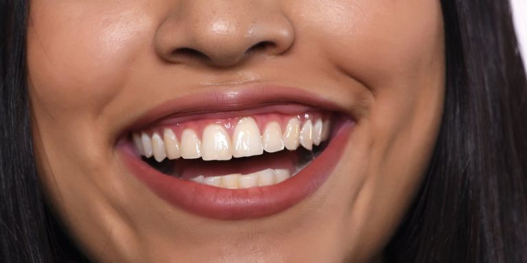 Somriure ampli en què es veu la geniva per sobre de les dents de dalt