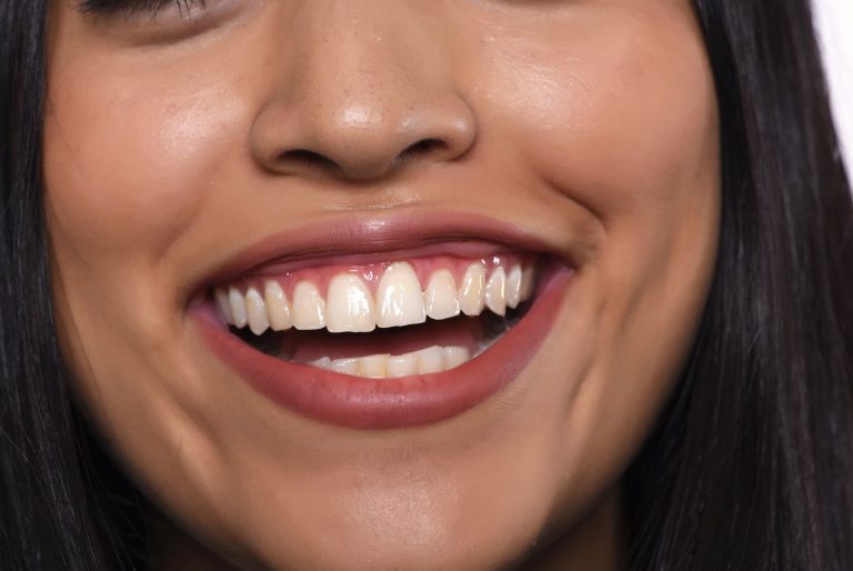Sonrisa amplia en la que se ve la encía por encima de los dientes superiores