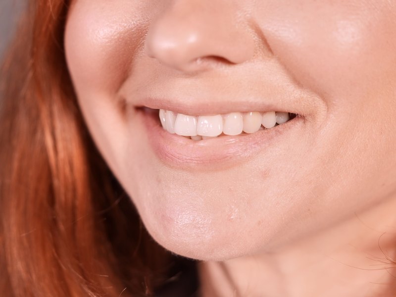 Sonrisa de una mujer con el labio superior cubriendo la encía y los dientes claros y regulares