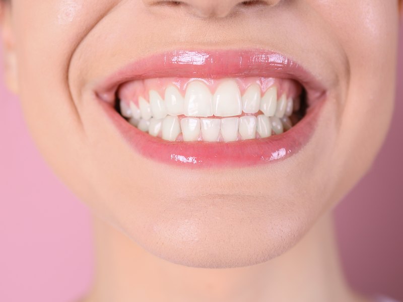 Boca de una mujer sonriendo con la encía superior a la vista por encima de los incisivos