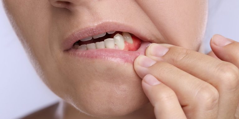 Red, swollen gum next to a tooth, with the lip pulled back