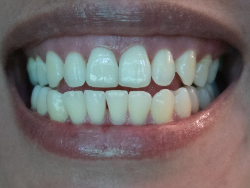Close-up of an open smile showing both rows of teeth