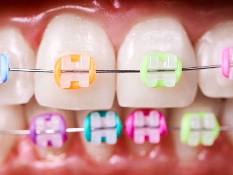 Ortodòncia amb brackets