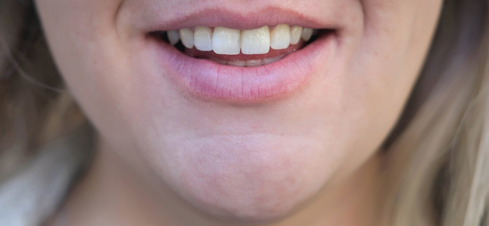 Somriure d'una dona amb les dents d'un to uniforme després d'un tractament estètic