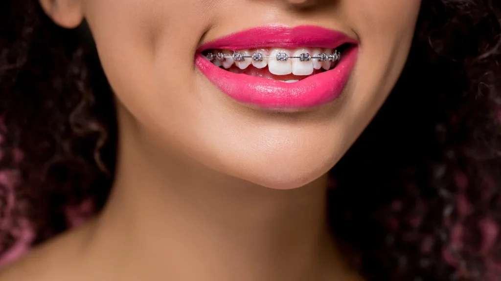 Brackets autoligables
