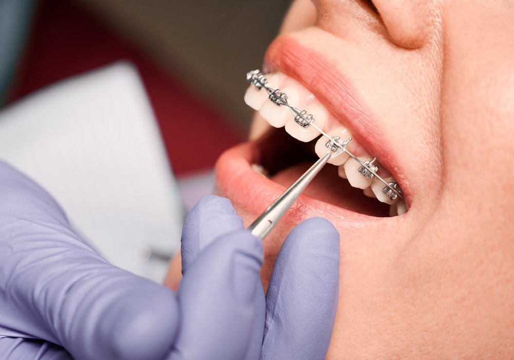 Brackets metálicos