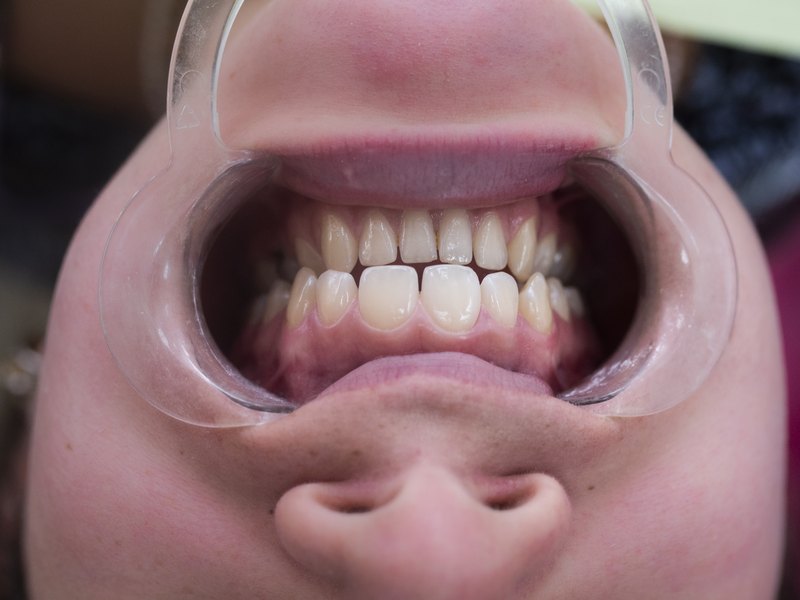 Boca abierta con separador de labios para revisar las encías en la consulta